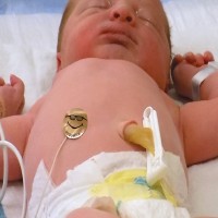Skin Probe Sensor for Infant radiant Warmer
